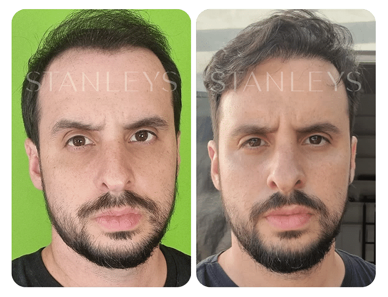 Antes-e-Depois_LP-22.png